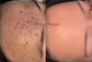 pattanásos bőr