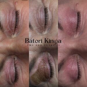 logó felsőszemhéj